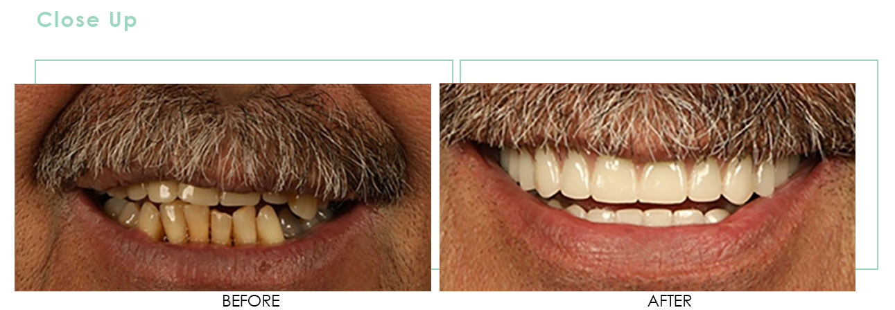 1 Dental Implant Smile Makeover Closeup