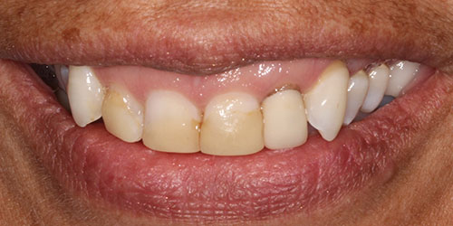 Cosmetic Dentistry 2 - Before