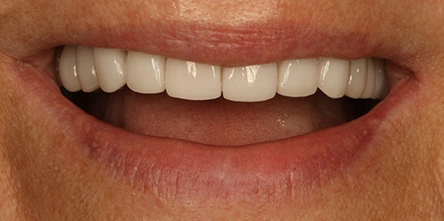 Cosmetic Dentistry 2 - After