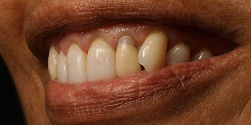Cosmetic Dentistry 2 - Before