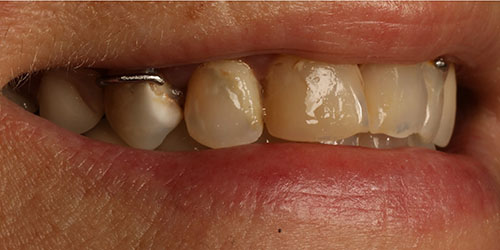 Dental Implant Cosmetic Dentistry 3 - Before