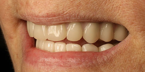 Dental Implant Cosmetic Dentistry 3 - After