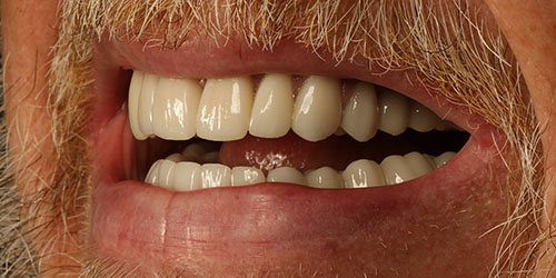 Dental Implant Cosmetic Dentistry 2 - After