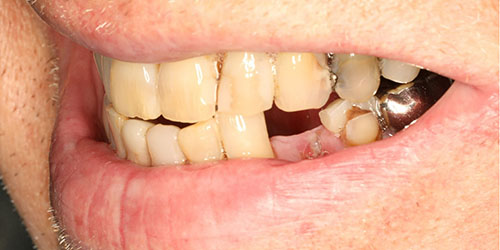 Dental Implant Cosmetic Dentistry 2 - Before